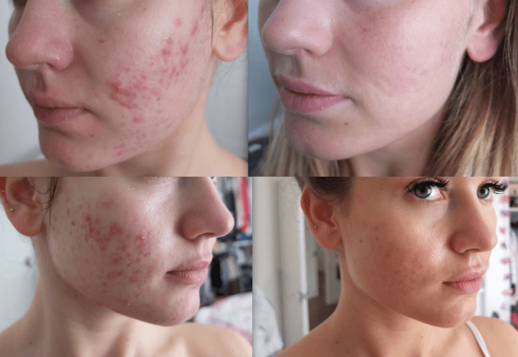 svale slå Polar My struggle with Acne + going on Roaccutane - We Are Global Travellers